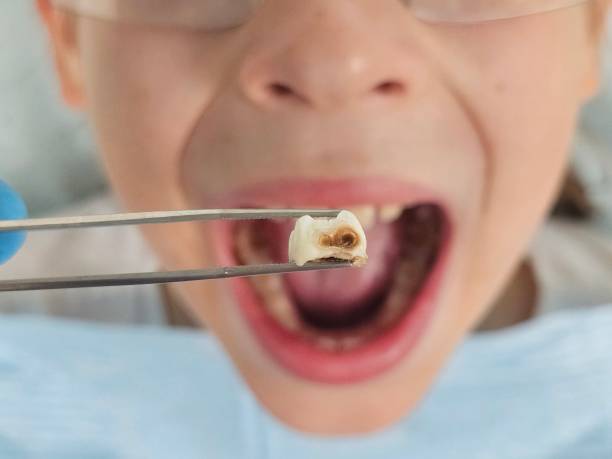 Best Emergency Wisdom Tooth Extraction in Rosemead, CA